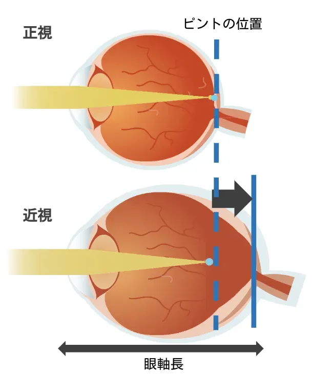 正視と近視の眼球断面図 — 眼軸長の違いによるピント位置の変化